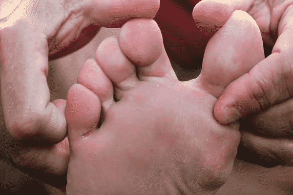 علاج الفطريات بين اصابع القدمين