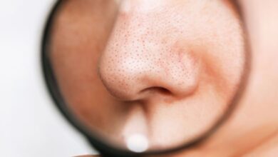 nose with blackheads
