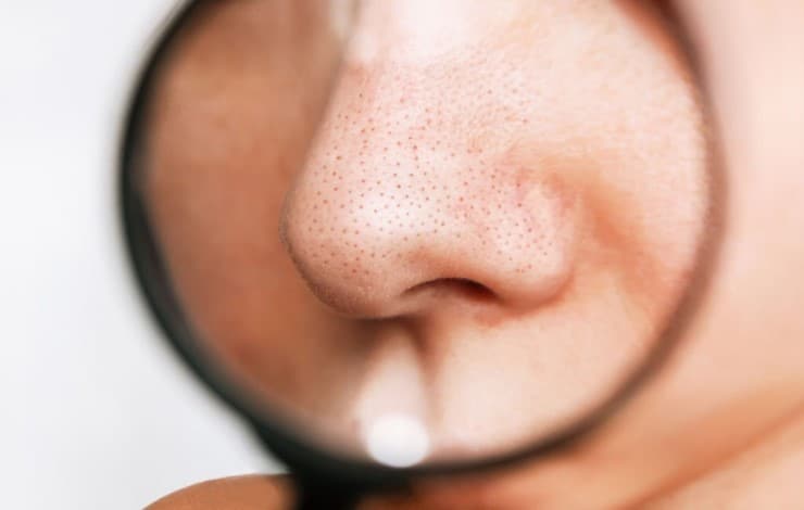 nose with blackheads