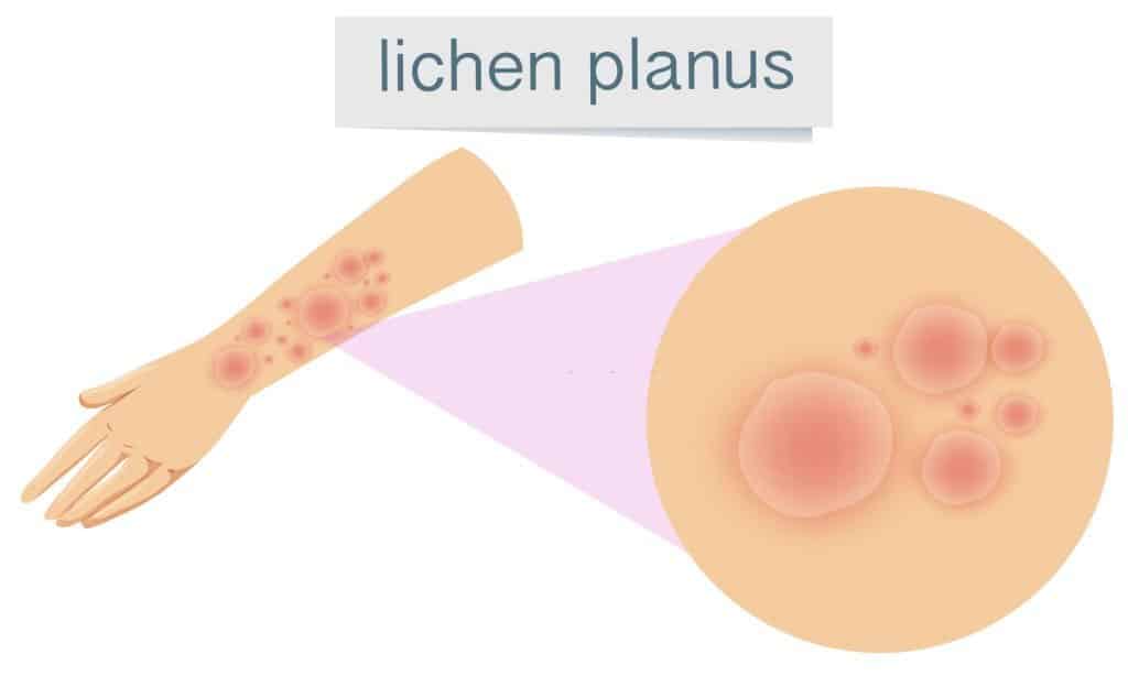 Lichen Planus 