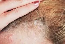 hair psoriasis