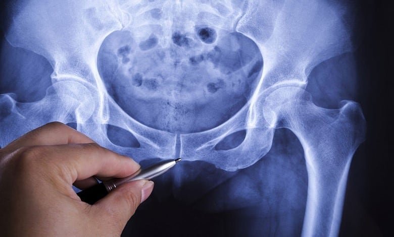 human Pelvis x-ray